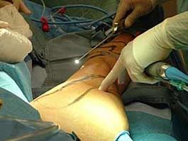 varicose veins (c) docturs cause vene varicose arti inferiori