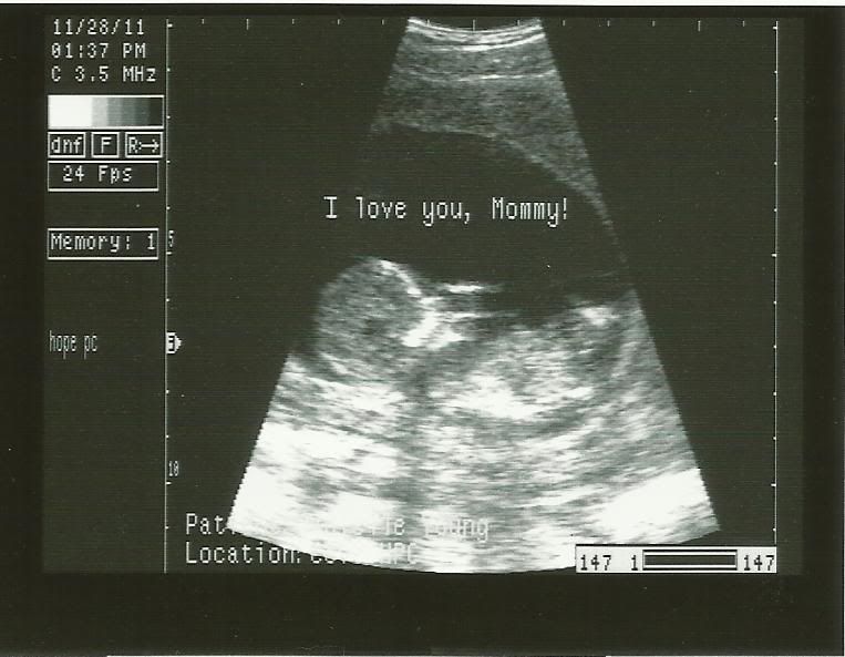 13 weeks 3 days Ultrasound